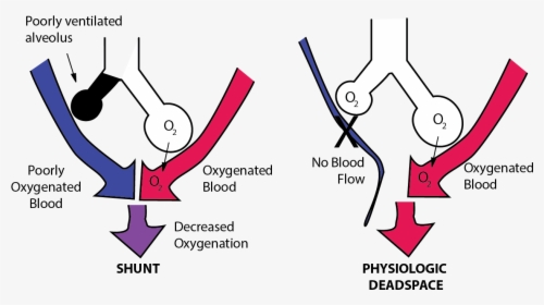 Imbalance Between Perfusion And Ventilation Is Called - Pulmonary Shunt, HD Png Download, Transparent PNG