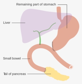 Pancreaticoduodenal Resection, HD Png Download, Transparent PNG