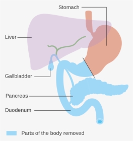 Total Pancreatectomy, HD Png Download, Transparent PNG