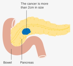 Pancreatic Cancer, HD Png Download, Transparent PNG