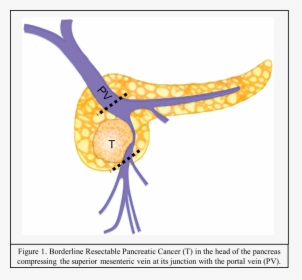 Tumor Borderline De Pancreas, HD Png Download, Transparent PNG
