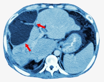 Imaging - Liver Cancer Ct Scan, HD Png Download, Transparent PNG