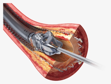 Stent Restenosis, HD Png Download, Transparent PNG