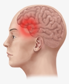 Migraine Pain In Head, HD Png Download, Transparent PNG