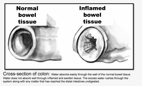 Inflamed Bowel, HD Png Download, Transparent PNG