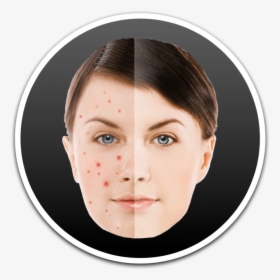 How To Remove Pimples And Blemish From Photos On Mac - Acne, HD Png Download, Transparent PNG