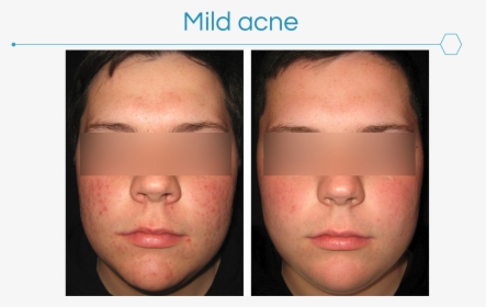 Picture3 - Acne Cosmetica, HD Png Download, Transparent PNG