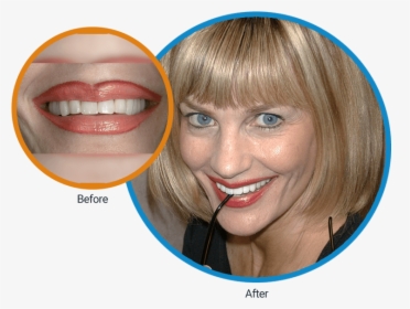 Close-up Before Of Diane S Mouth And Then An After - Girl, HD Png Download, Transparent PNG