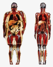 Obesity Human Body Adipose Tissue Anatomy Connective - Fat Person Vs Skinny Person, HD Png Download, Transparent PNG