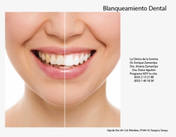 Aesthetic Teeth Restoration, HD Png Download, Transparent PNG