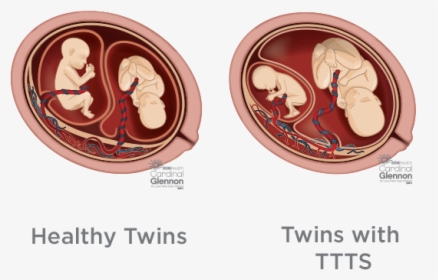 Image Of Healthy Twins In The Womb, Vs Image Of Twins - Twin-to-twin Transfusion Syndrome, HD Png Download, Transparent PNG