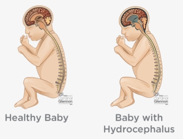 Hydrocephalus - Spina Bifida Before And After, HD Png Download, Transparent PNG