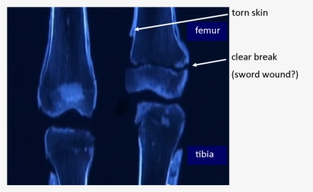 Tut S Leg Bones - Radiography, HD Png Download, Transparent PNG
