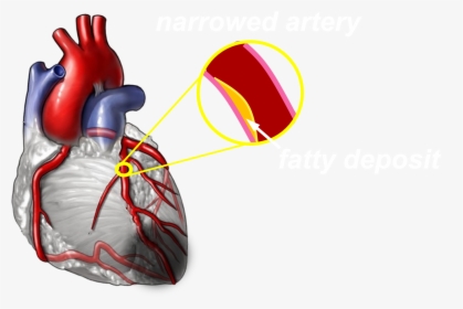 Moderate - Blocked Heart Arteries, HD Png Download, Transparent PNG