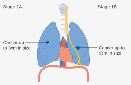 Cough Clipart Lung Cancer, HD Png Download, Transparent PNG