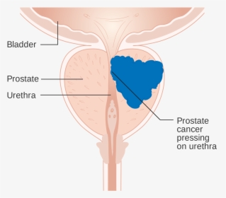 Prostate Cancer Diagram    Class Img Responsive Lazyload, HD Png Download, Transparent PNG