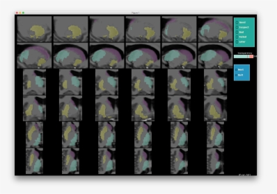 Images/subcortical Multiple, HD Png Download, Transparent PNG