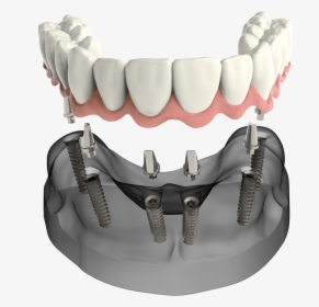 Implant Secured Denture Sudbury Ma Dentist, HD Png Download, Transparent PNG