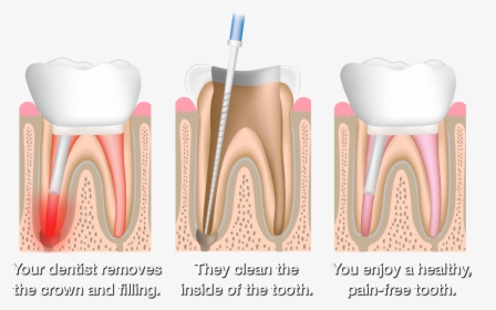 Root Canal Therapy, HD Png Download, Transparent PNG