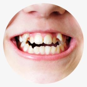 Do Teeth Grow Crooked - Irregular Teeth, HD Png Download, Transparent PNG