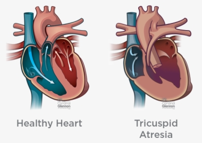 Tricusp#atresia - Truncus Arteriosus Heart, HD Png Download, Transparent PNG