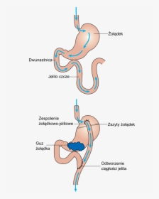 Diagram Showing Before And After Stomach Bypass Surgery, HD Png Download, Transparent PNG