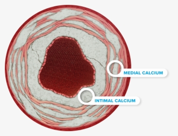 Calcium Right - Intimal Calcium, HD Png Download, Transparent PNG