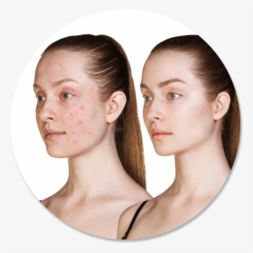 Galvanic Facial Treatment Before And After, HD Png Download, Transparent PNG