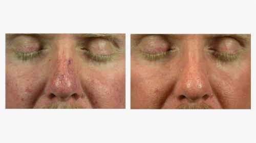 Photo Rejuvenation Skin Tightening - Facial Expression, HD Png Download, Transparent PNG