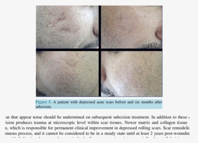A Patient With Rolling & Icepick Acne Scars Before - Subcision On Trauma Scars, HD Png Download, Transparent PNG