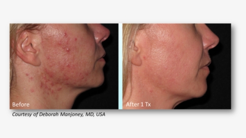 Manjoney - Infini Acne Scars Before And After, HD Png Download, Transparent PNG