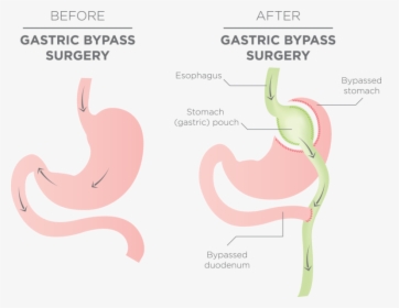 Stomach Before And After Gastric Bypass, HD Png Download, Transparent PNG