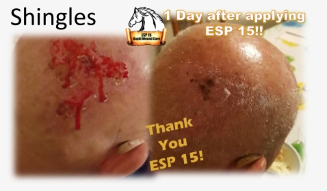 Esp 15 Used On Shingles On The Back Of A Man S Head - Bun, HD Png Download, Transparent PNG