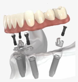 All On 4 Dental Implants - All-on-4, HD Png Download, Transparent PNG