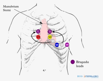 Brugada Syndrome Ecg Placement, HD Png Download, Transparent PNG