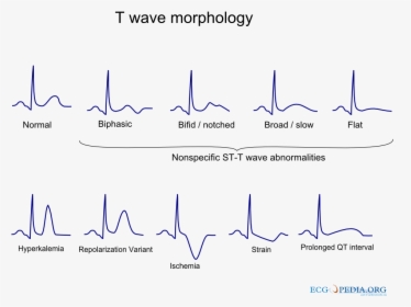 T Wave Abnormality, HD Png Download, Transparent PNG