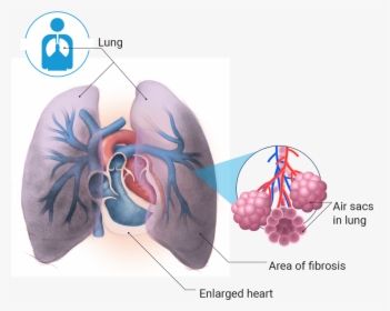 Transparent Lung Png - Pulmonary Hypertension Png Transparent, Png Download, Transparent PNG