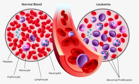 Leukemia Therapeutics Market Acute Myeloid Leukemia, - Blood Cancer, HD Png Download, Transparent PNG