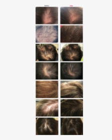 Dr Cyj Hair Filler Before And After, HD Png Download, Transparent PNG