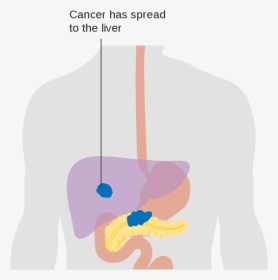 Illustration Pancreatic Cancer, HD Png Download, Transparent PNG