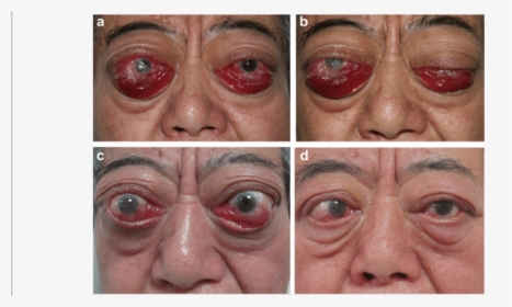 Old Man Face Png -ophthalmologic Symptoms Of The Patient - Orbital Decompression Graves, Transparent Png, Transparent PNG