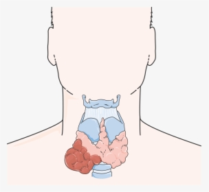 Cancer De La Thyroïde - Thyroid Cancer Cartoon, HD Png Download, Transparent PNG