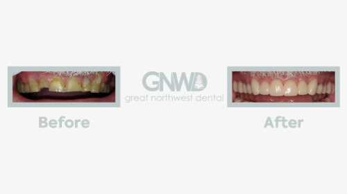 1teeth - Invisalign Before And After Wdult, HD Png Download, Transparent PNG