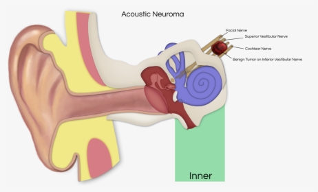 Vestibular Schwannoma Affected Nerves, HD Png Download, Transparent PNG