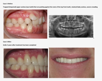 Bad Teeth Braces Before And After, HD Png Download, Transparent PNG
