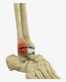 Ankle Fracture Repair Los Angeles - Fractured Ankle, HD Png Download, Transparent PNG