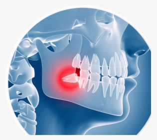 X-ray Illustration Of An Impacted Wisdom Tooth - Wisdom Teeth Removal, HD Png Download, Transparent PNG