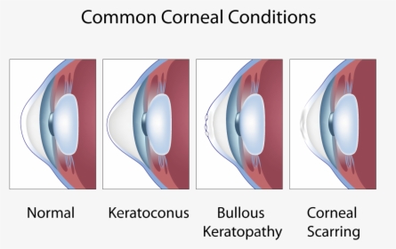 Common Corneal Conditions - Keratoconus And Astigmatism, HD Png Download, Transparent PNG