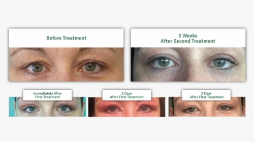 Results Of A Non-surgical Eye Lift - Plasma Iq Eye Lift, HD Png Download, Transparent PNG