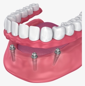 All On 4 Lower Denture - Implant Supported Denture, HD Png Download, Transparent PNG